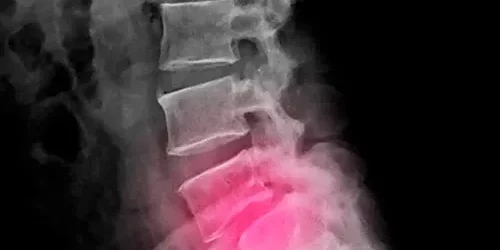 Espondilolistesis