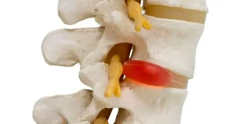 Hernias-de-Disco