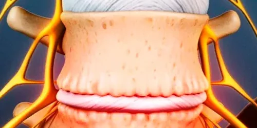 Radiculopatía-lumbar
