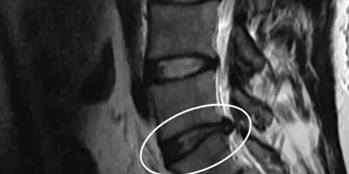 hernia-de-disco