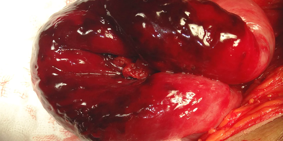 Intestino Delgado Estrangulado