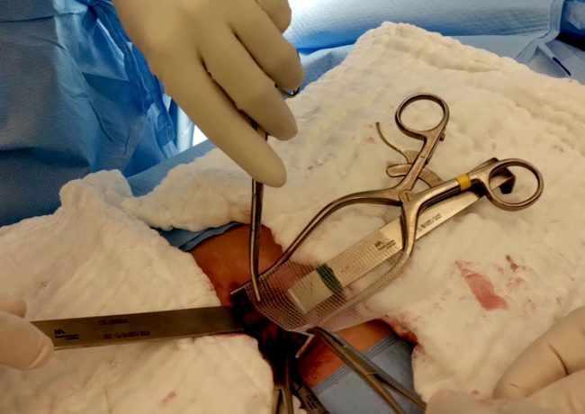 cirugia_pared_abdominal